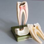 Tooth Model Showing Tooth Decay - Trade Winds Dental