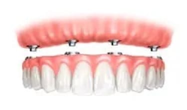All-on-4 Implant Supported Dentures - Trade Winds Dental