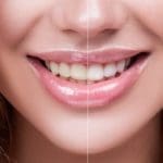 Teeth Whitening - Trade Winds Dental