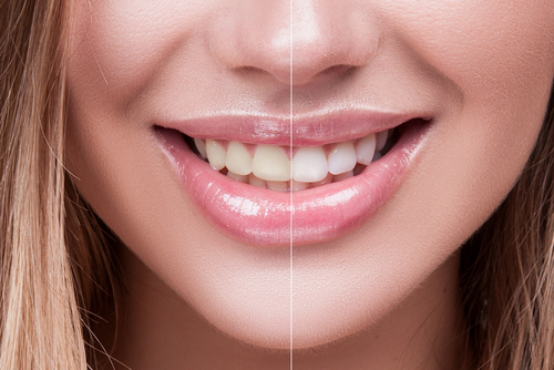Split Image Of Before And After Teeth Whitening