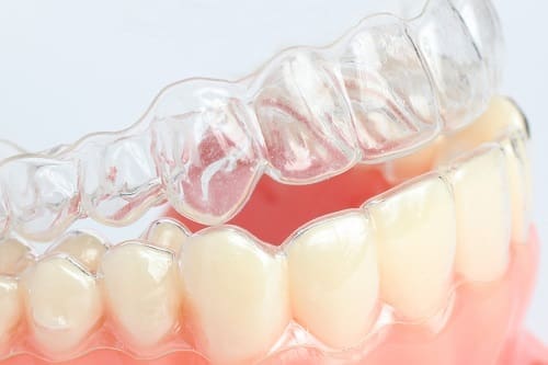 Invisalign - Trade Winds Dental