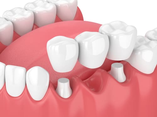 3D model of Dental Bridge - Trade Winds Dental