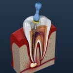 Root Canal Treatment - Trade Winds Dental