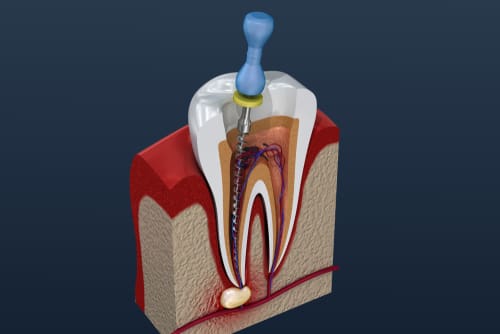 Root Canal Treatment - Trade Winds Dental