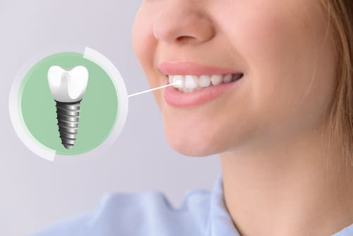 Woman with dental implant - Trade Winds Dental