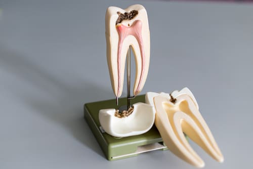 Model tooth with cavities - Trade Winds Dental