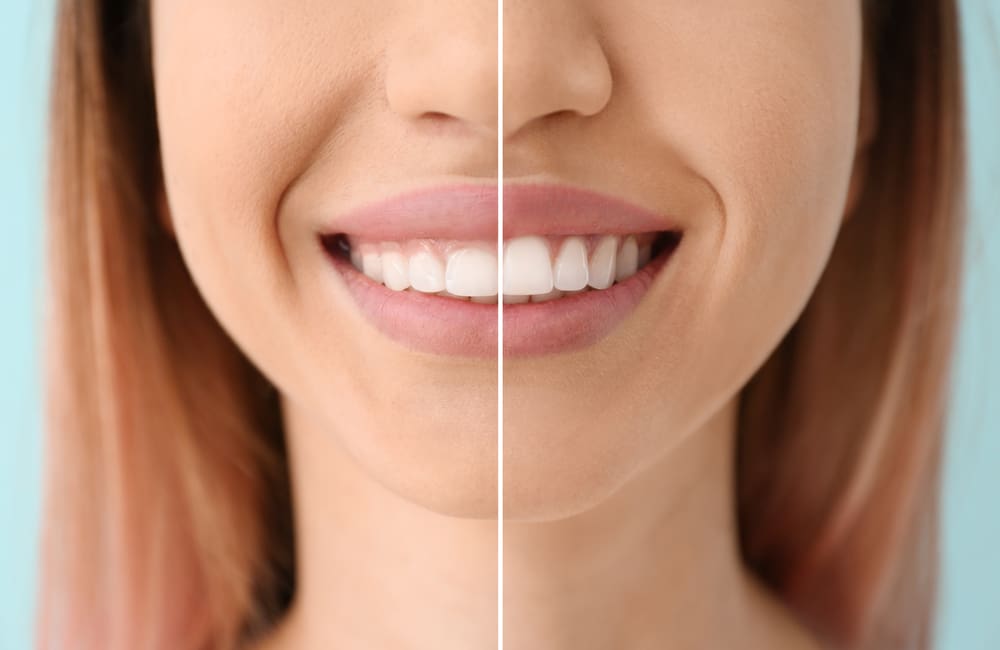 Before and After Gum Lift - Trade Winds Dental