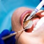 Examining teeth for inlays and onlays - Trade Winds Dental