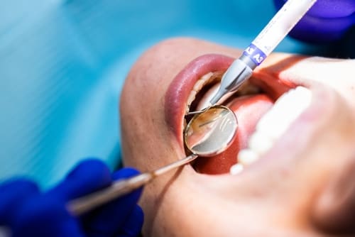 Examining teeth for inlays and onlays - Trade Winds Dental