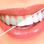 Teeth Whitening Results In Georgetown, TX - Trade Wind Dental