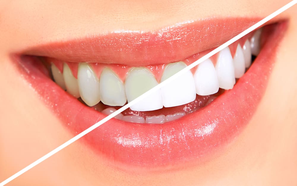 Teeth Whitening Results In Georgetown, TX - Trade Wind Dental
